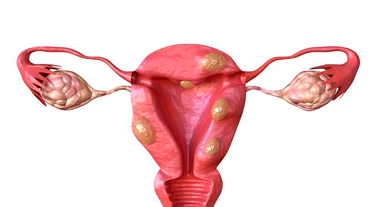 Fibromas uterinos (miomas)